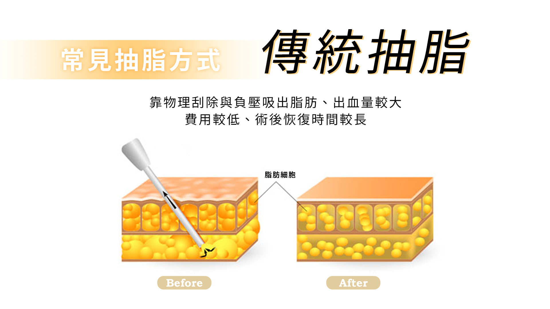 傳統抽脂