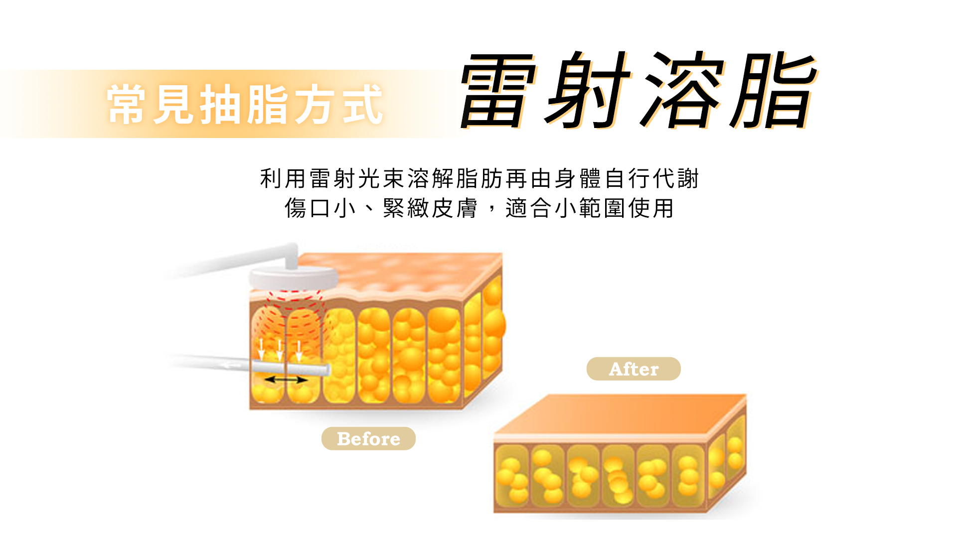 雷射溶脂