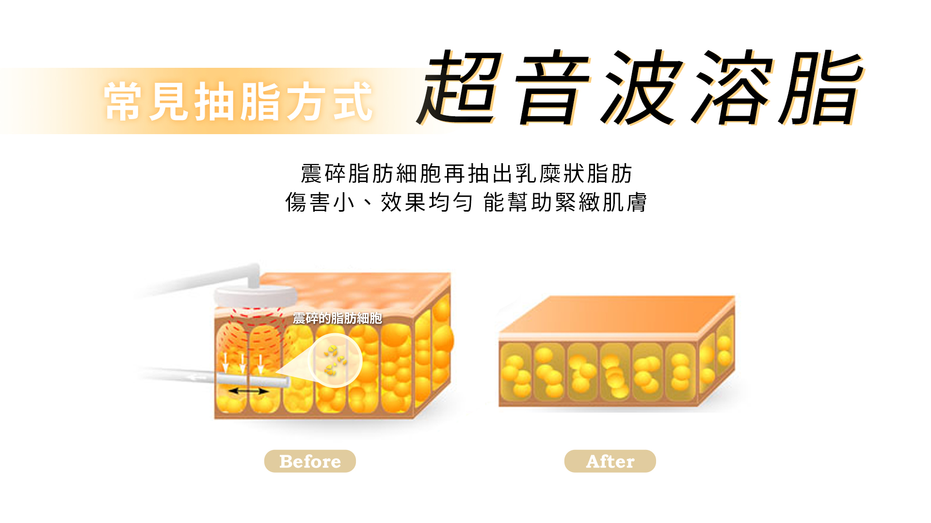 超音波溶脂