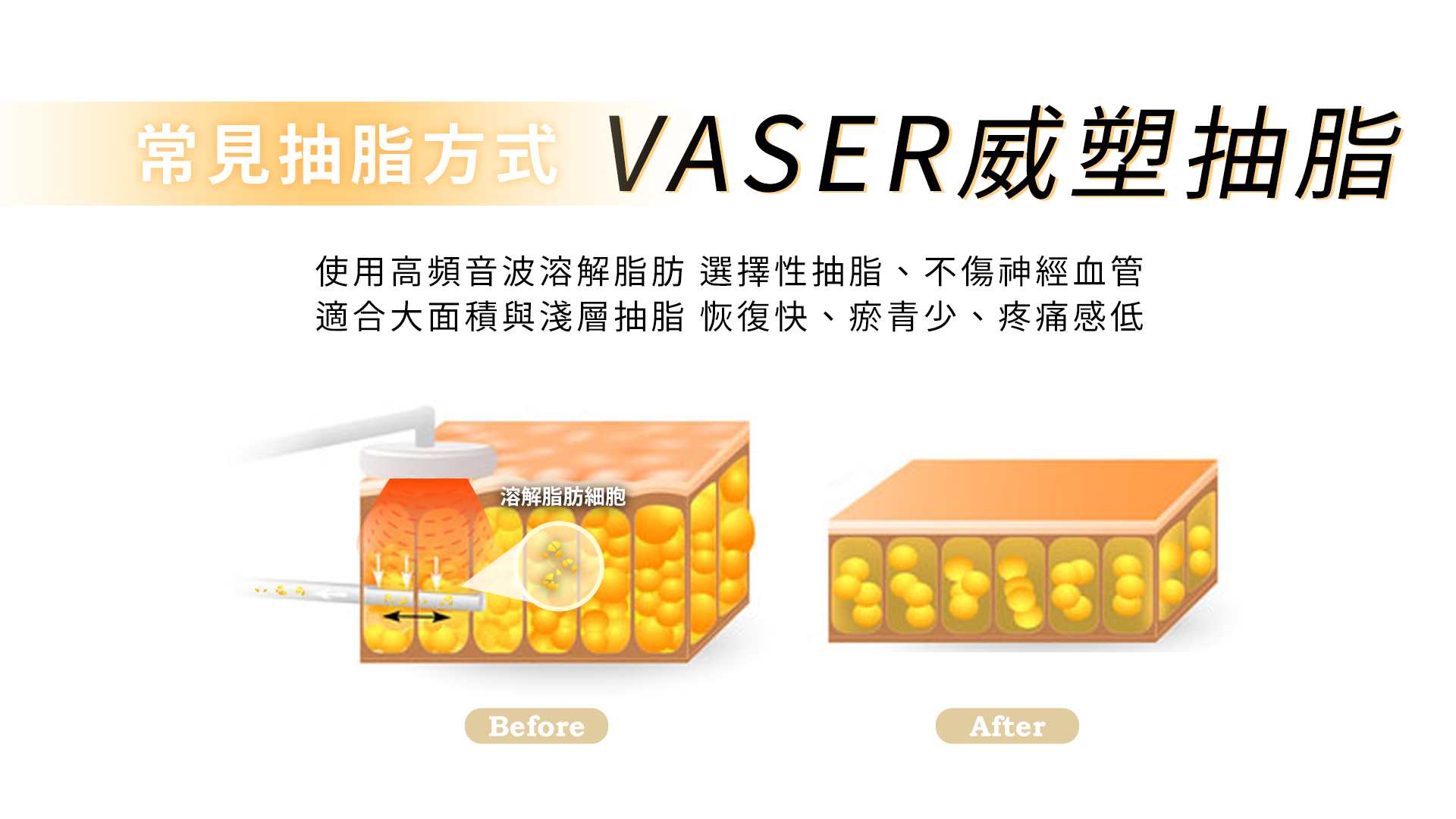 威塑抽脂