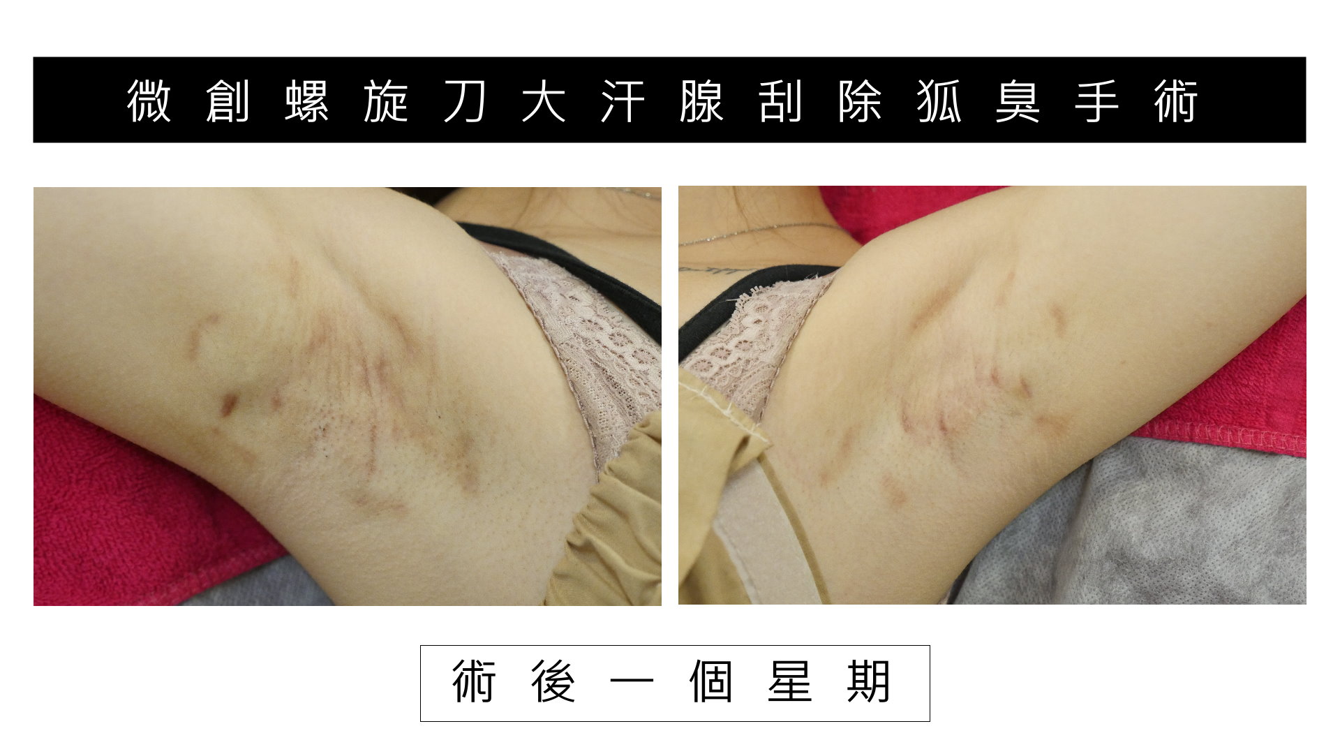 台南狐臭手術價格費用，除狐臭手術推薦醫師02