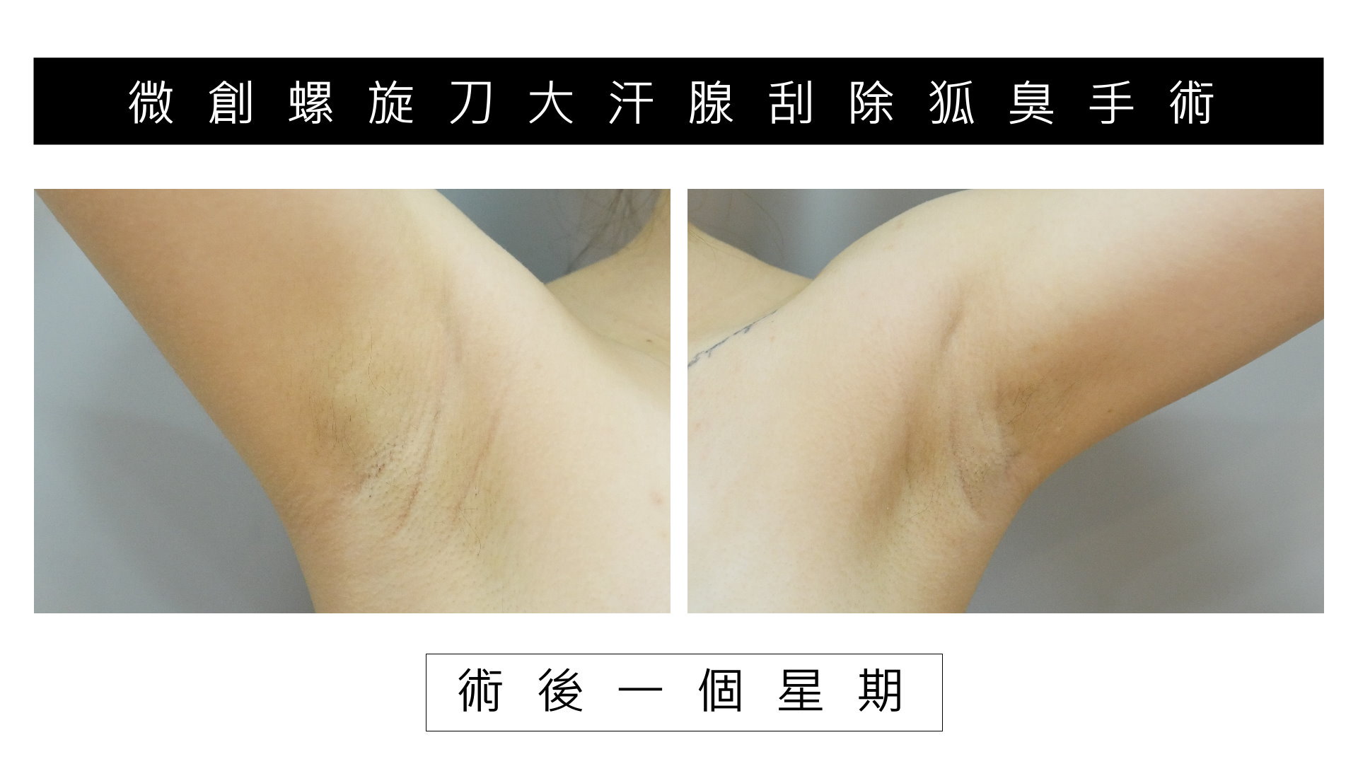 台南狐臭手術價格費用，除狐臭手術推薦醫師03